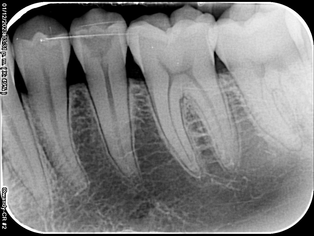Radiografías intraorales
